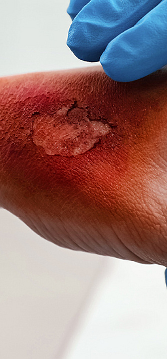 Die Zukunft der Verbrennungsmedizin/Foto: New Africa/AdobeStock