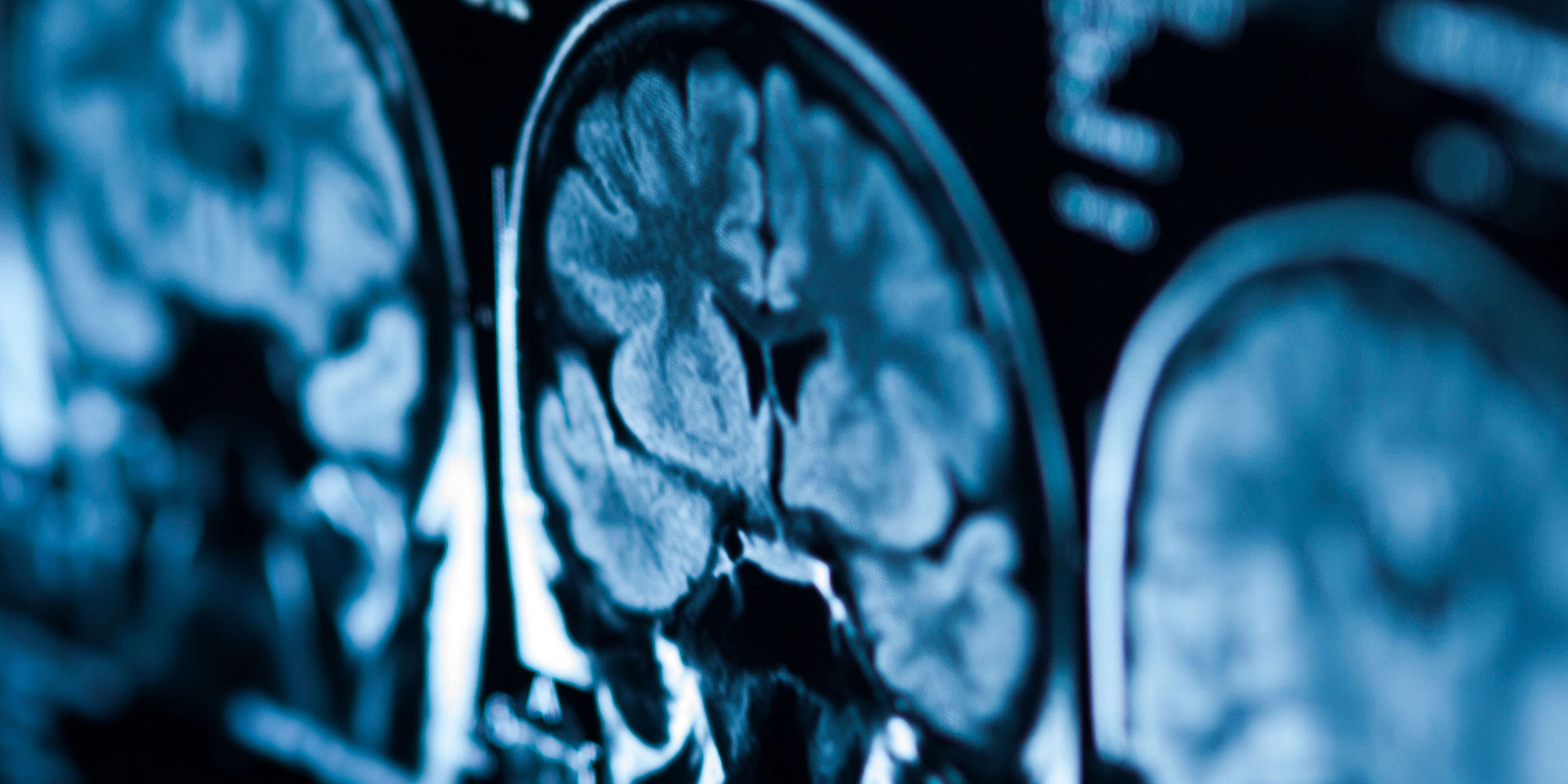 Tomography pictures of the brain