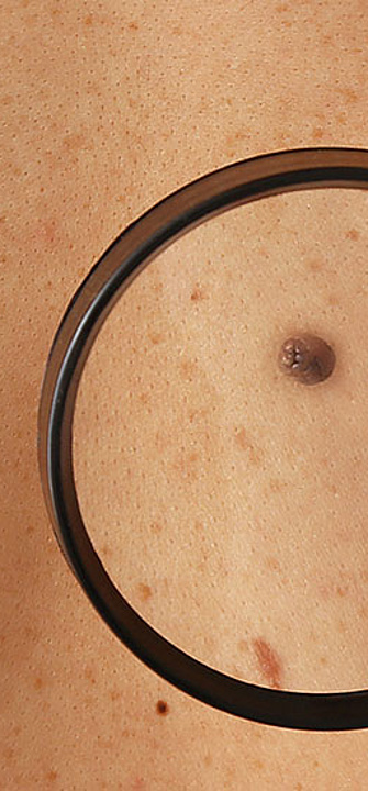 Hautkrebs - Pixel-Shot/AdobeStock