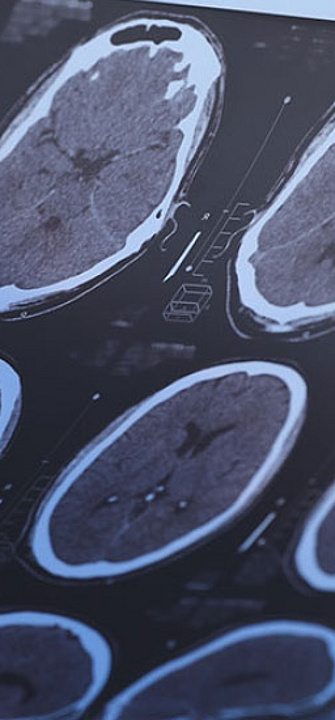 MS ist bislang nicht heilbar - Foto: New Africa/AdobeStock.com