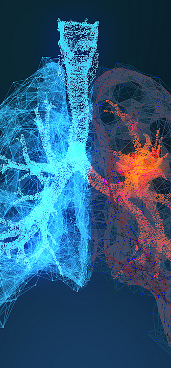 3D-gerenderte Illustration von Lungenkrebs