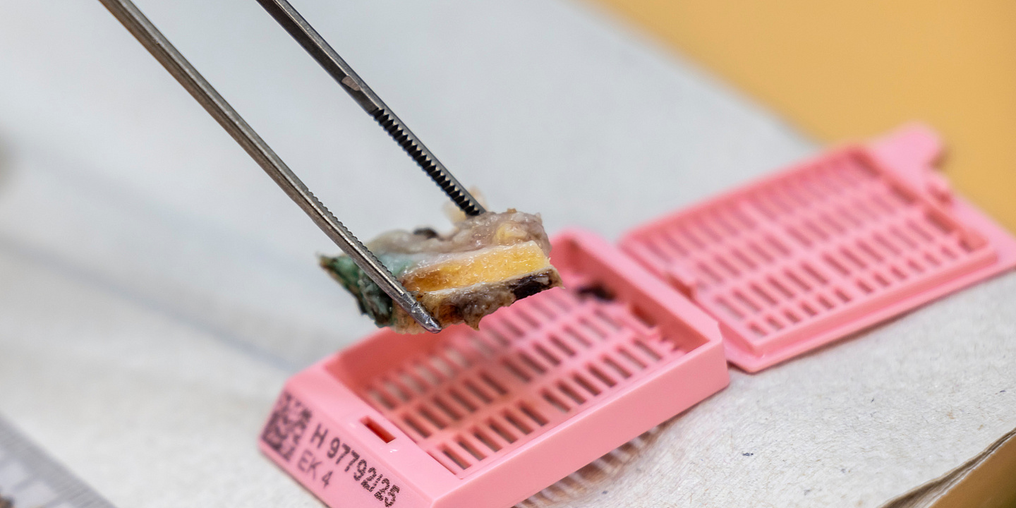 Gewebeprobe wird auf der Pathologie analysiert