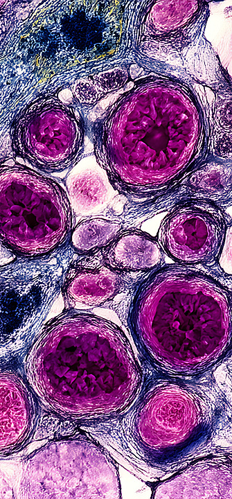 Licht aktiviert Chemotherapie gezielt am Tumor