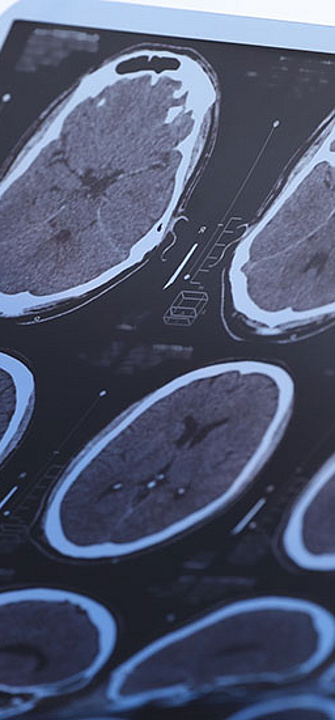 Multiple Sklerose - New Africa/AdobeStock