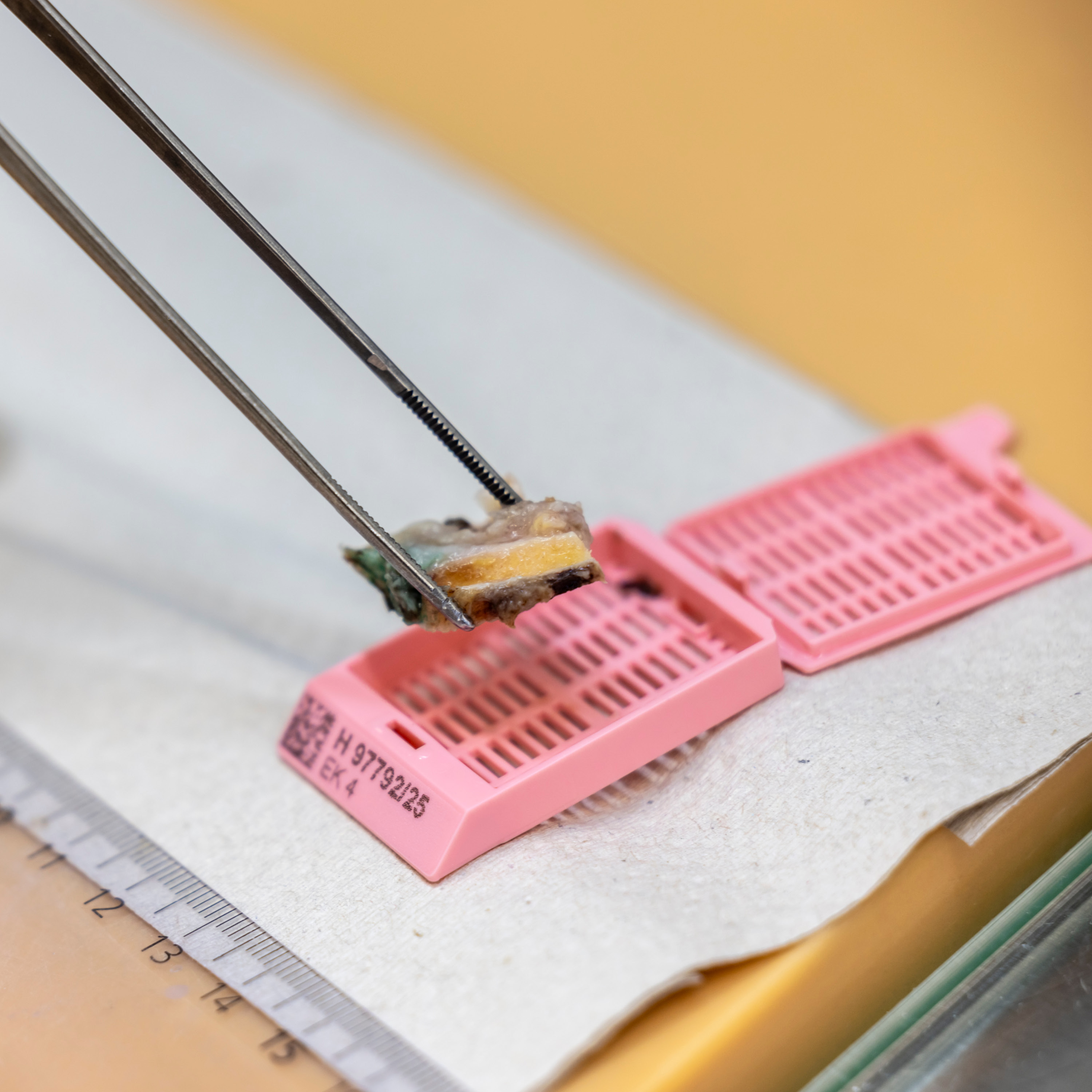 Gewebeprobe wird auf der Pathologie analysiert