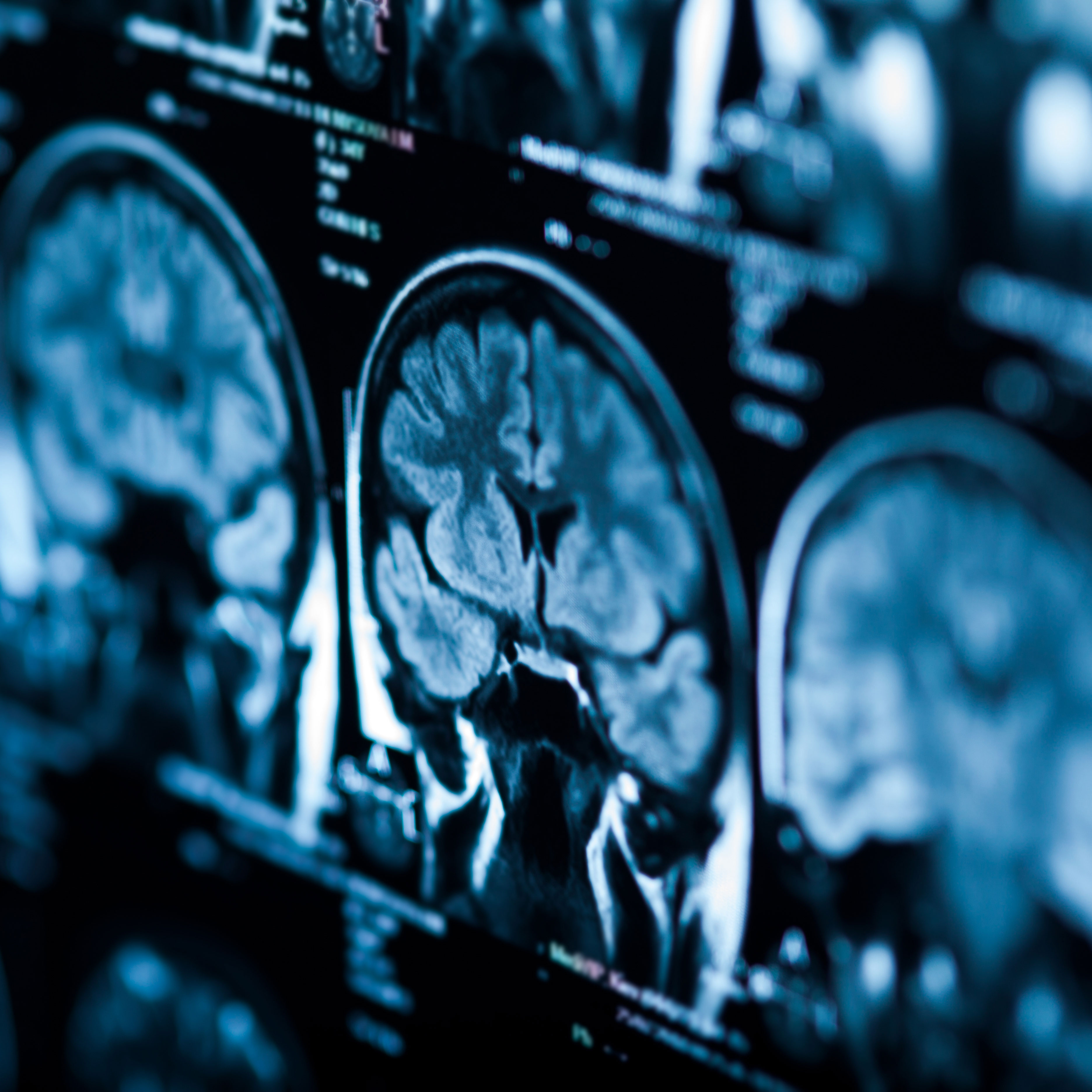 Tomography pictures of the brain